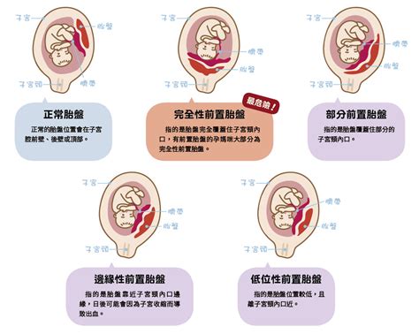 胎盤靠近子宮頸|認識「前置胎盤」4種型態及主要症狀｜Mombaby 媽 